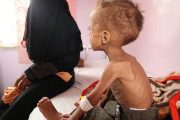 Faisal, 18 months old is treated for severe acute malnutrition at Sabeen hospital in Yemen’s capital Sana’a.