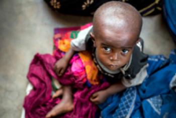 Child with malnutrition awaits treatment.