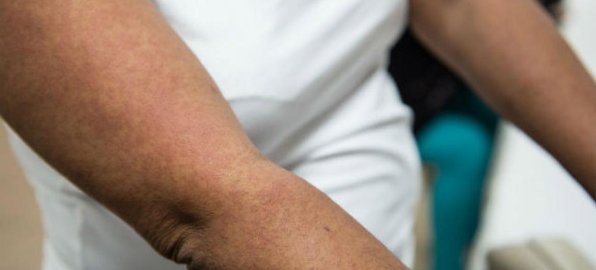 Chikungunya, um vírus transmitido pelo Aedes aegypti mosquito, entre as doenças que afetaram população da região. Foto: OMS/Paho/Luz Sosa