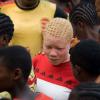Apelo visa combater os ataques frequentes contra albinos. Foto: ONU/Marie Frechon