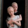 Dia Mundial de Consciencialização do Albinismo. Foto: Unicef Moçambique