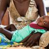 Criança com desnutrição severa em Juba, no Sudão do Sul. Foto: Unicef/UN053447/Gonzalez Farran