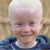 Crianças com albinismo muitas vezes sofrem abusos em África Austral. Foto: Unicef Moçambique/ Sergio Fernandez