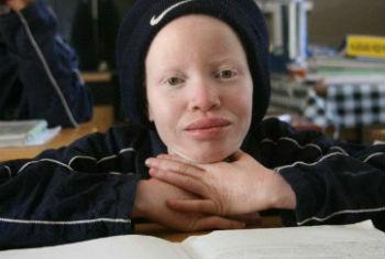 Criança albina. Foto: Unicef Namibia/2012/Manuel Moreno